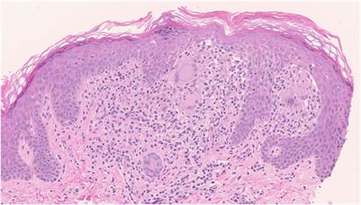 Case report: Comparative treatment course of generalized lichen nitidus: effectiveness of topical steroids versus maxacalcitol